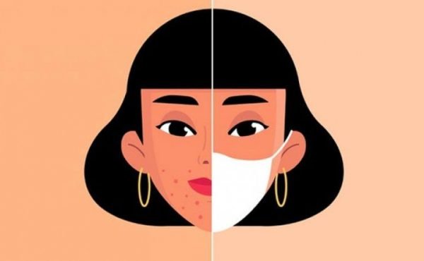 Maskne, cara mencegah maskne, cara mengobati maskne, apa itu maskne